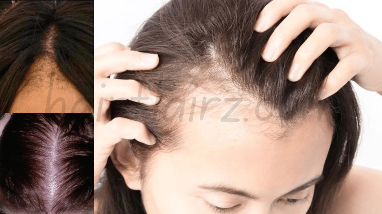 Androgenetic Alopecia