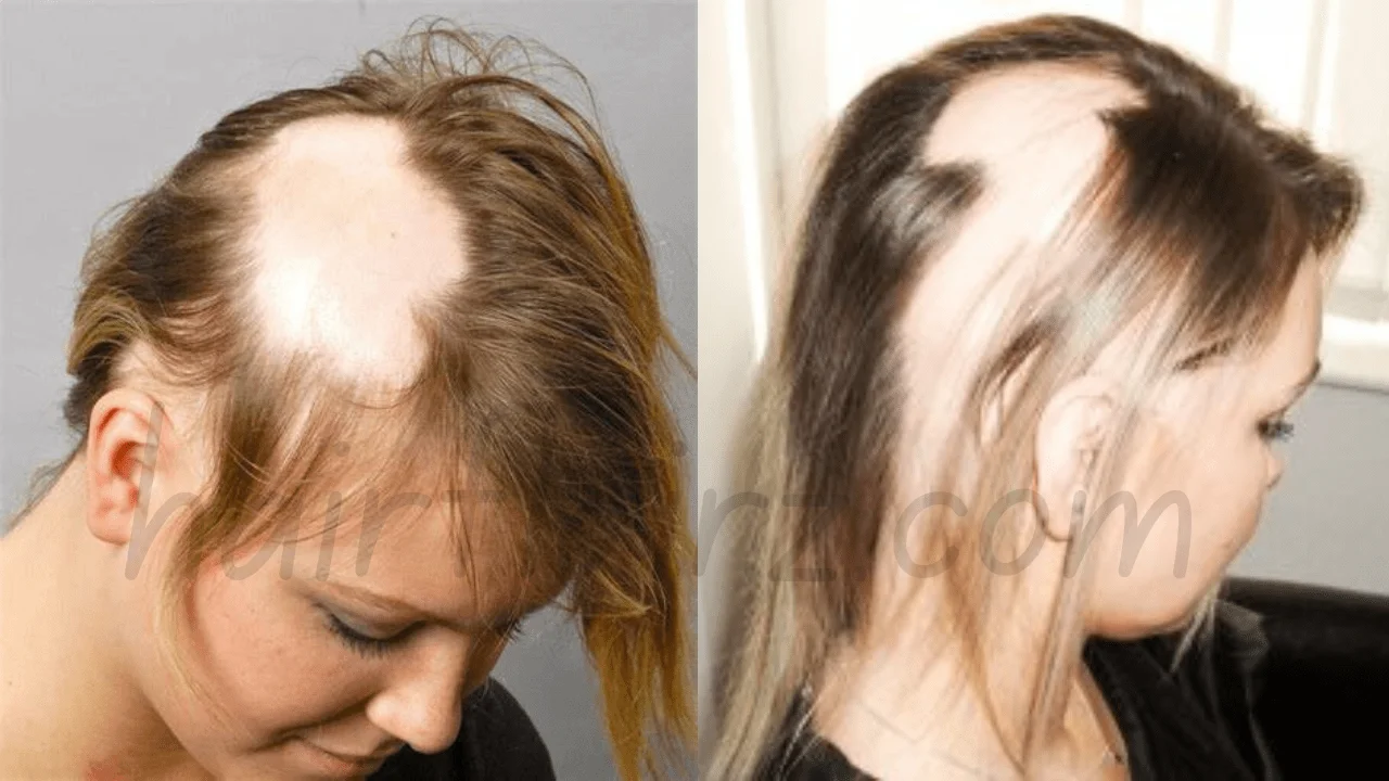 Alopecia Areata